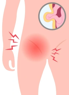 60 Especialista en Hernia Inguinal en Guadalajara