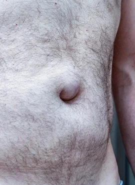 Cirugía de Hernia Estrangulada en Guadalajara
