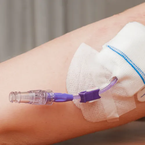 colocación de catéter para quimioterapia Cirugía General en Guadalajara