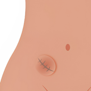Cirujano Especialista en Hernias en Guadalajara
