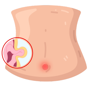 Cirujano Especialista en Hernias en Guadalajara