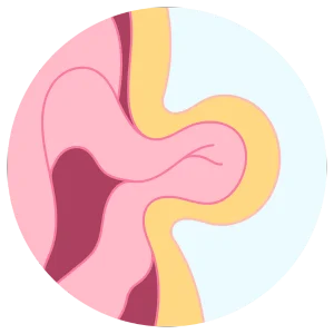 hernias Cirujano Gastroenterólogo en Guadalajara