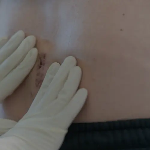 Inicio precio de cirugía de hernia umbilical en guadalajara