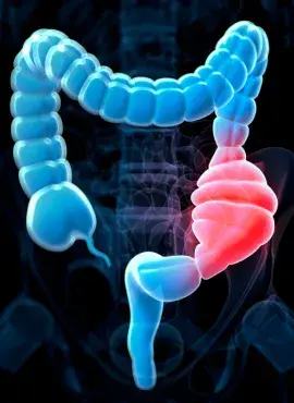 que pasa si no te cuidas de la colitis (1) Especialista en Colitis en Guadalajara
